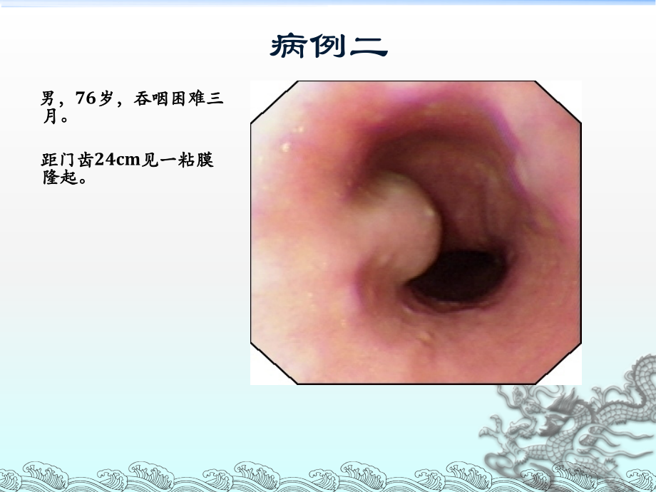 消化道隆起性病变的超声内镜诊断ppt课件.ppt_第3页