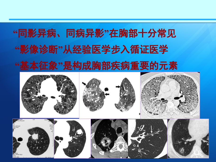 肺部征象诊断应用ppt课件.ppt_第2页