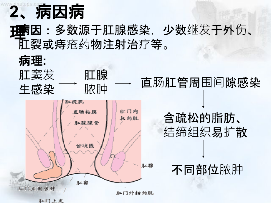 肛周脓肿护理查房ppt课件.ppt_第3页