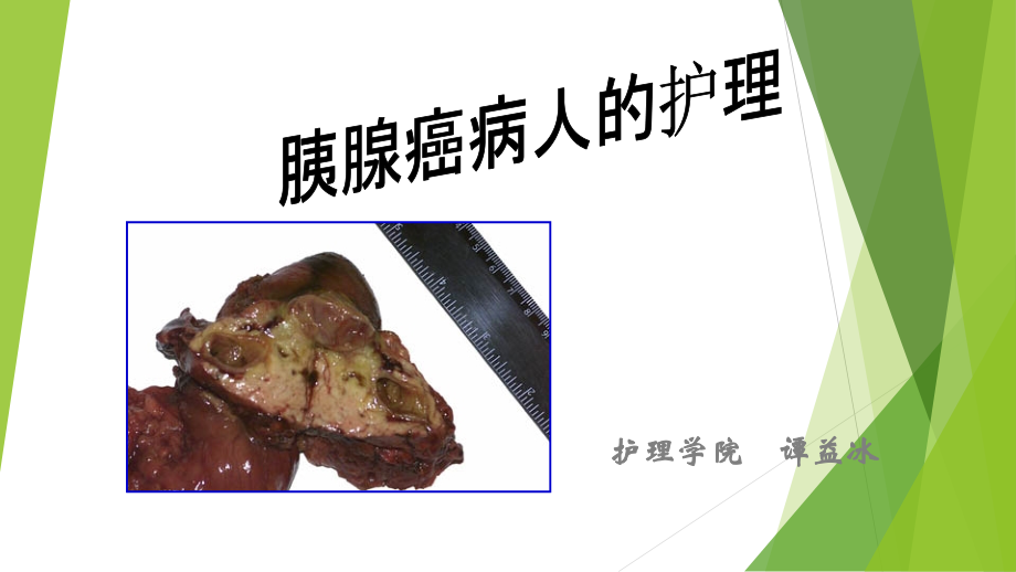 胰腺癌病人的护理-ppt课件.ppt_第1页