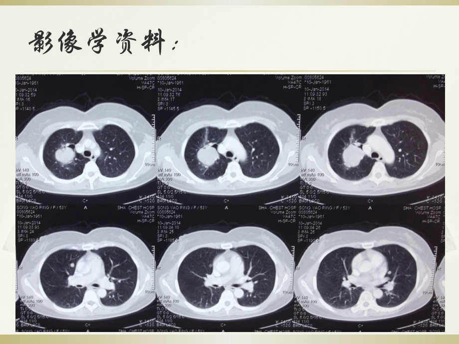 肺良性转移性平滑肌瘤病的诊治ppt课件.pptx_第3页