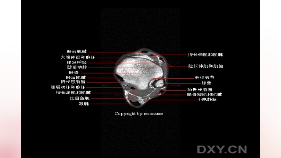 正常踝关节MR解剖ppt课件.ppt_第3页