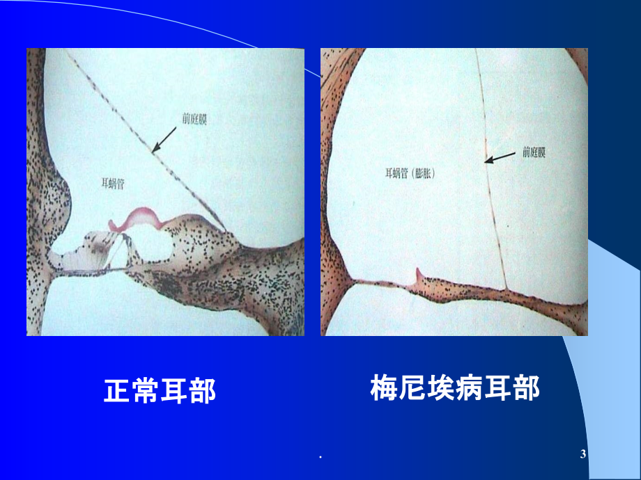 梅尼埃病及耳聋防治.ppt_第3页