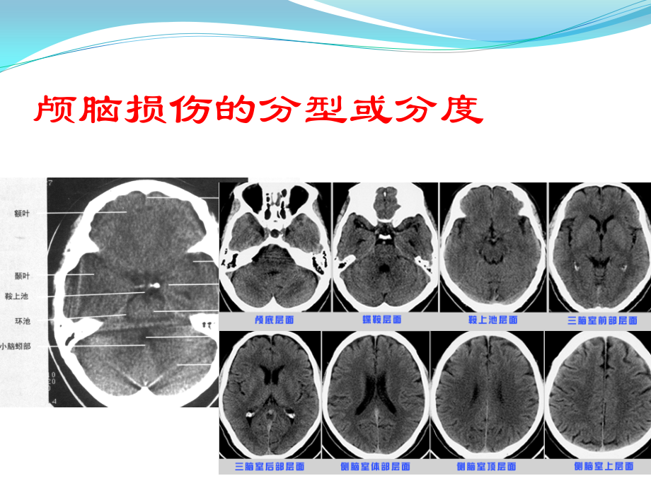 重度颅脑损伤监护与治疗.pptx_第2页