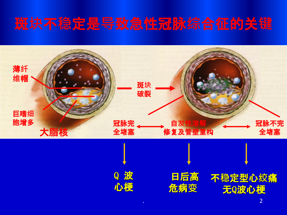 急性心肌梗死PPT课件.ppt_第2页