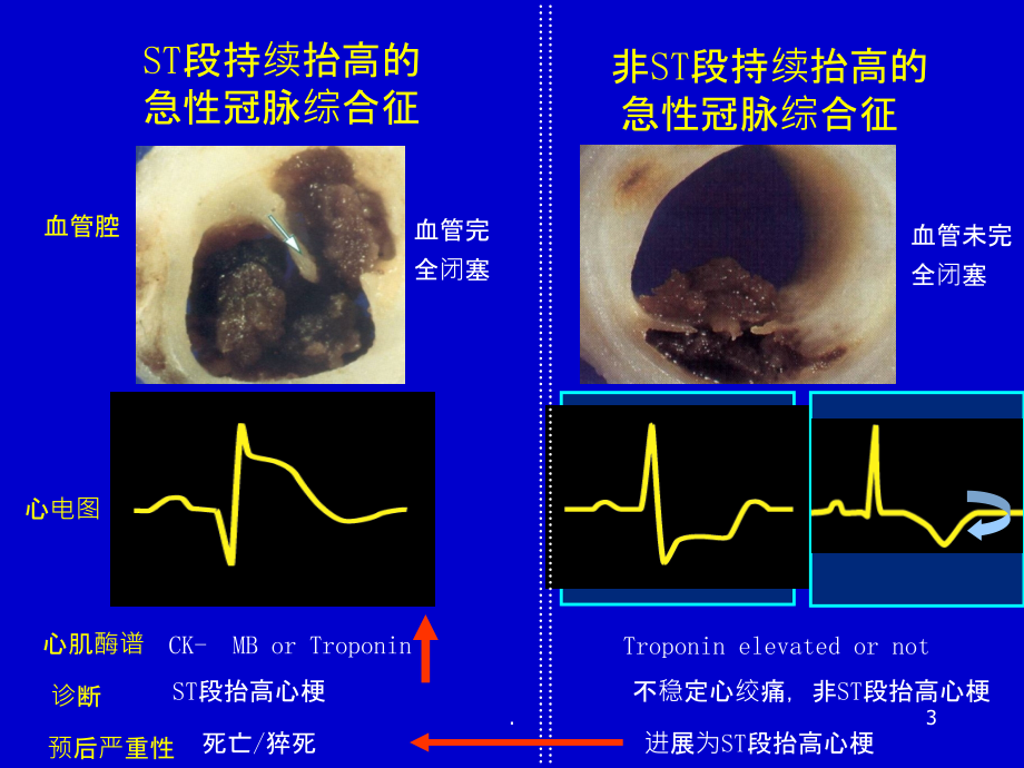 急性心肌梗死PPT课件.ppt_第3页