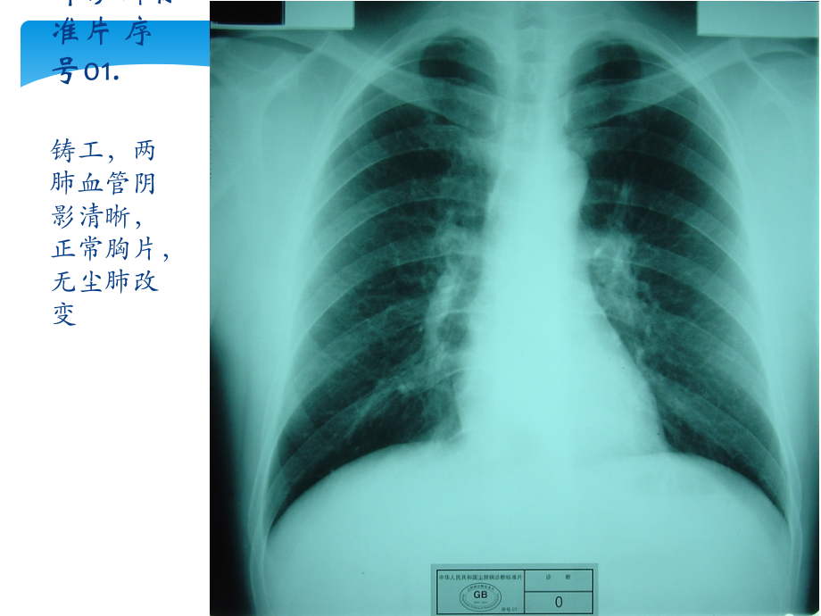 中华人民共和国尘肺标准片ppt课件.ppt_第2页