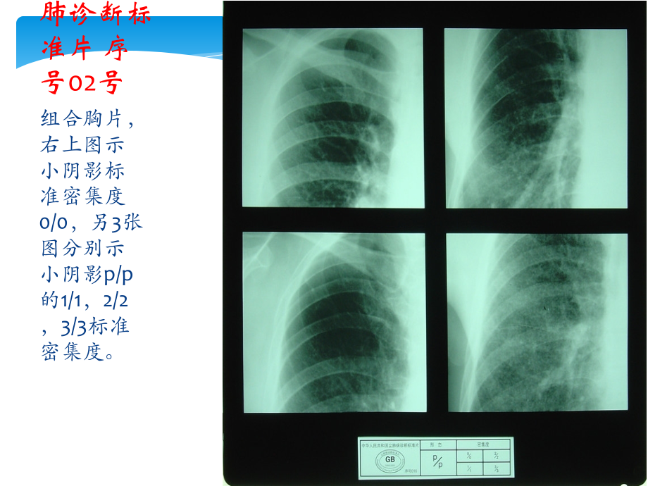 中华人民共和国尘肺标准片ppt课件.ppt_第3页