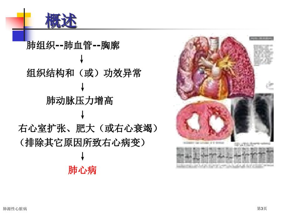 肺源性心脏病.pptx_第3页