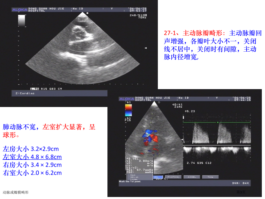 动脉或瓣膜畸形专家讲座.pptx_第3页