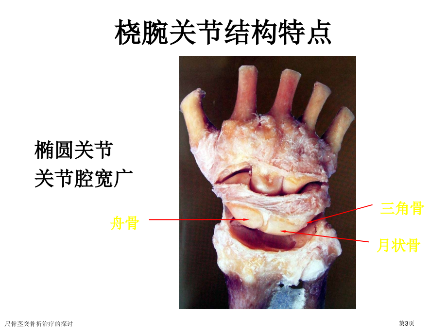 尺骨茎突骨折治疗的探讨.pptx_第3页