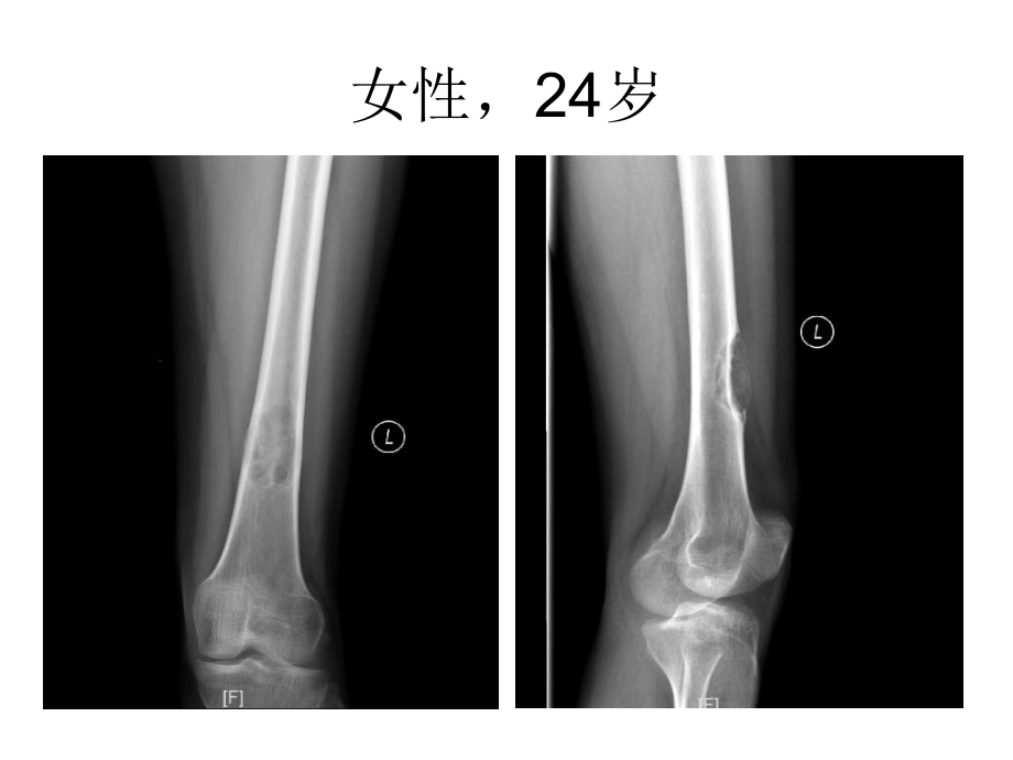 软骨粘液样纤维瘤的x线诊断及鉴别诊断.pptx_第3页