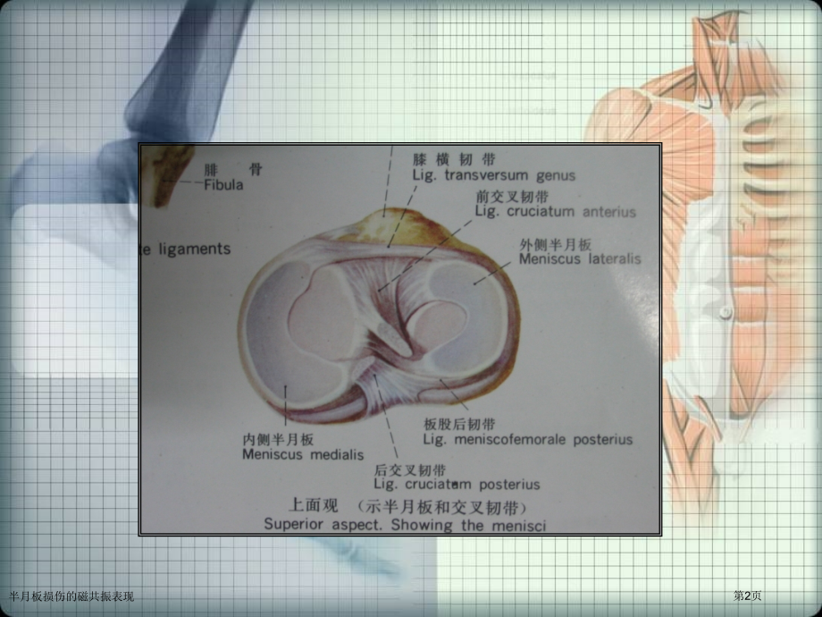 半月板损伤的磁共振表现.pptx_第2页