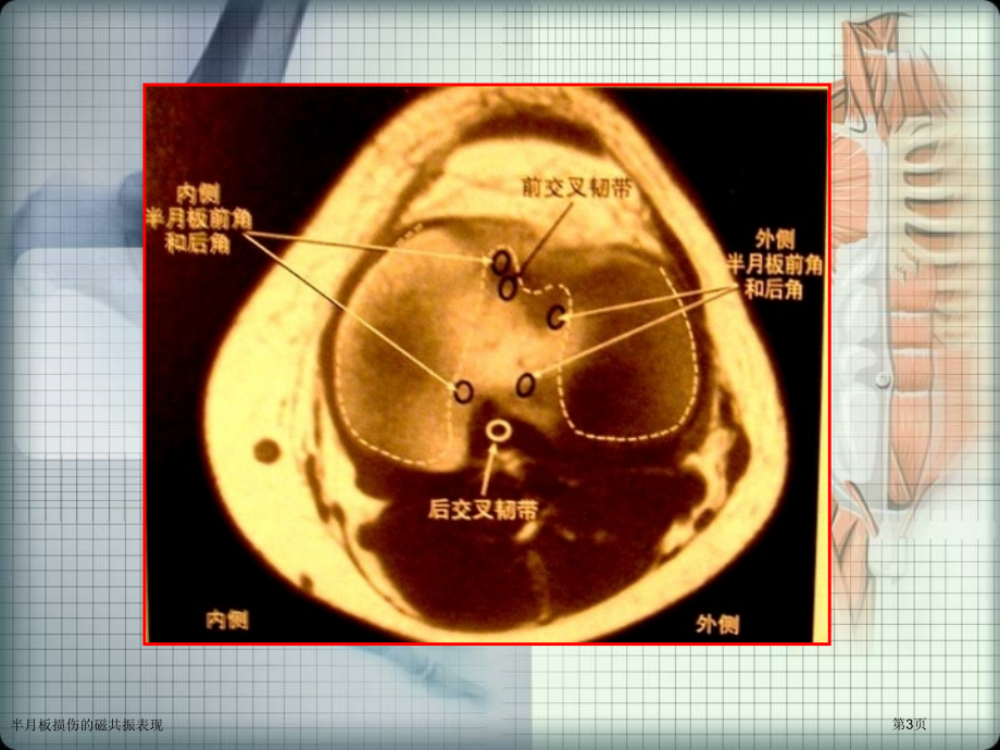 半月板损伤的磁共振表现.pptx_第3页