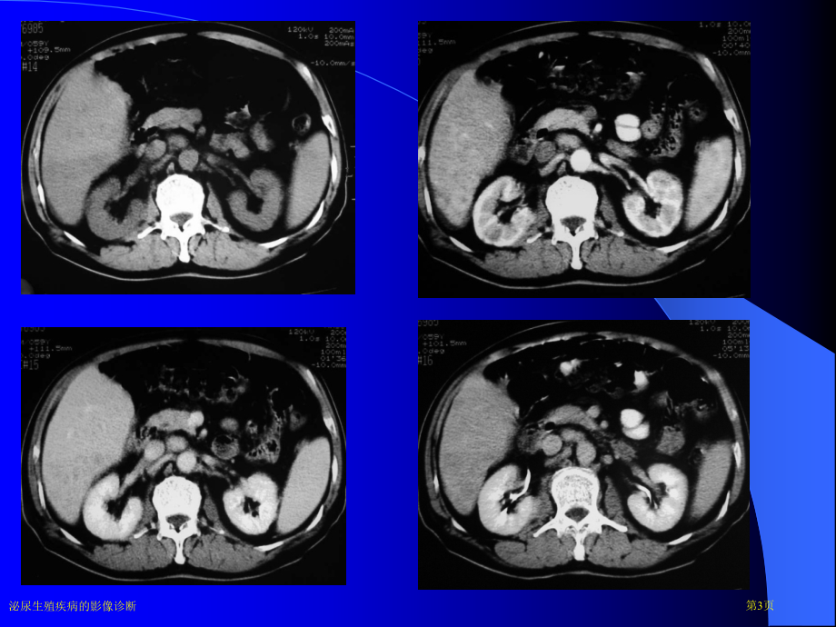 泌尿生殖疾病的影像诊断专家讲座.pptx_第3页