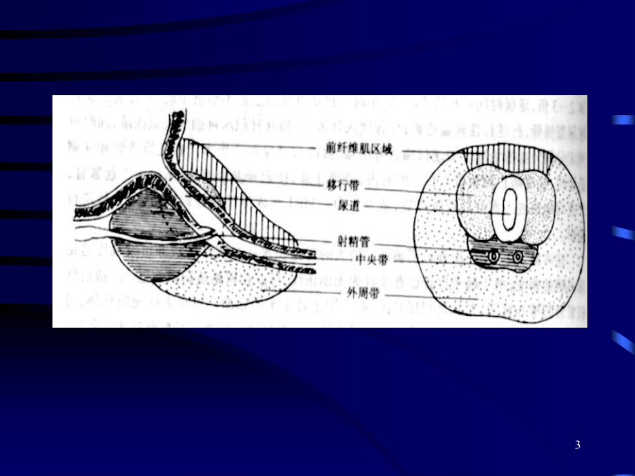 前列腺增生症的临床表现诊断和治疗.pptx_第3页