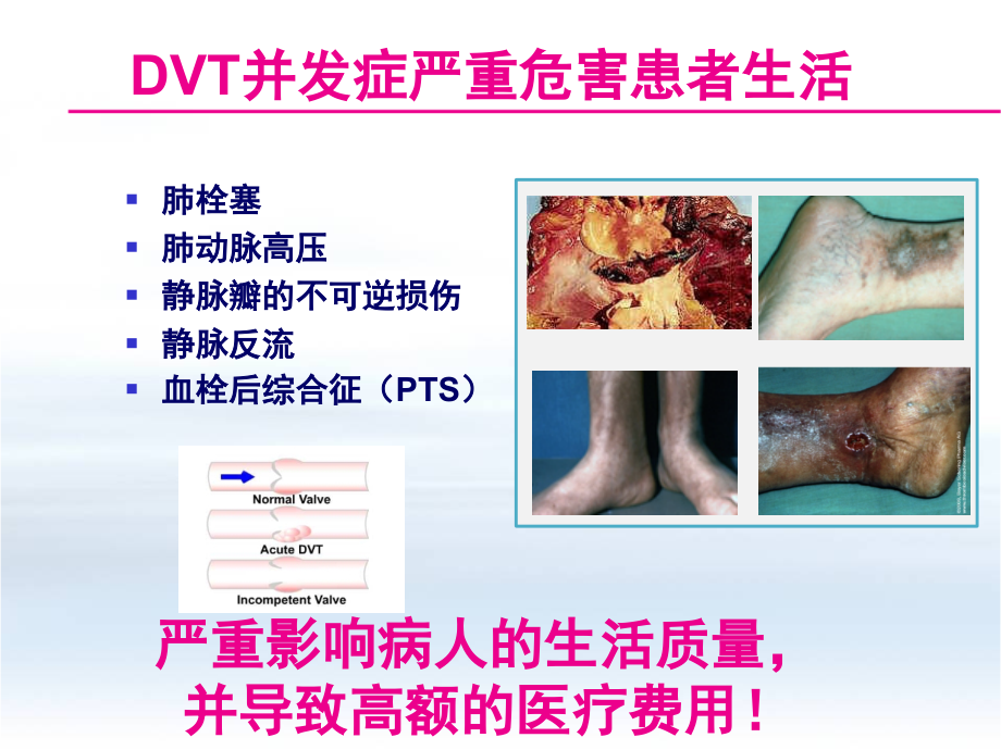 创伤骨科患者VTE预防.pptx_第3页