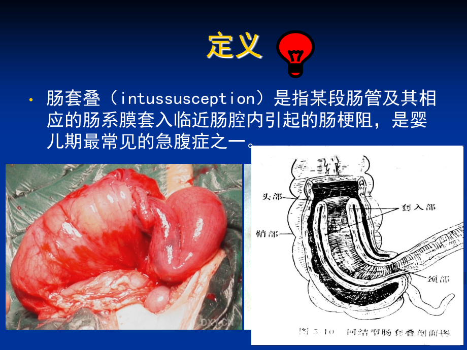 肠套叠空气灌肠复位技巧及注意事项--医学课件.ppt_第3页