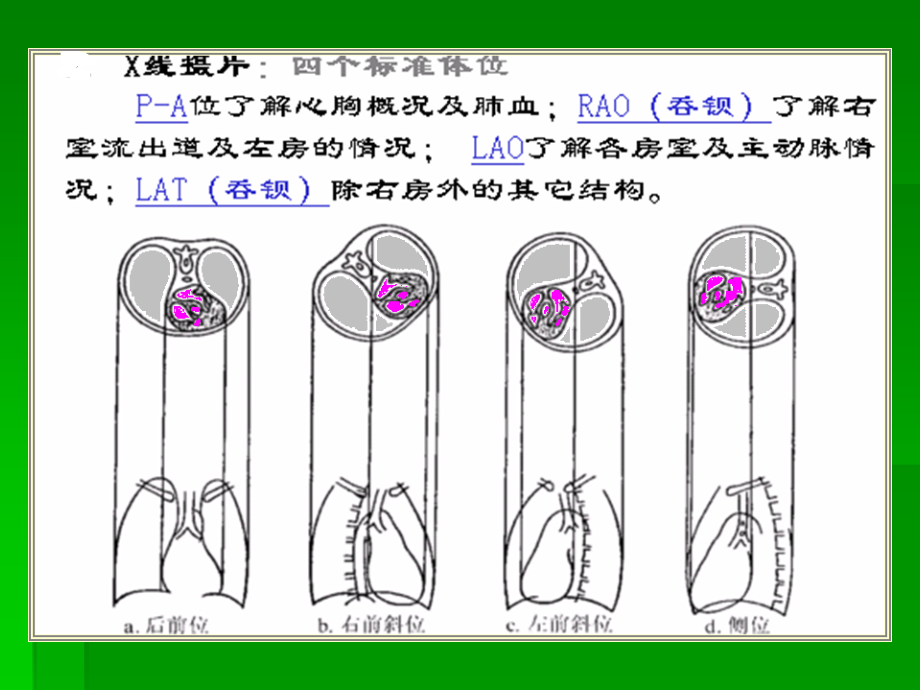 心脏大血管影像复习.ppt_第2页