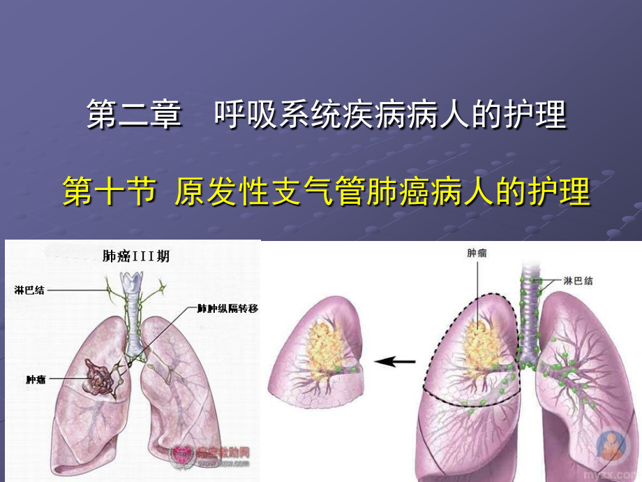 原发性支气管肺癌病人的护理详解.ppt_第1页