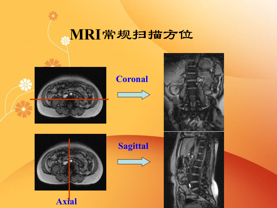 脊柱常见疾病的MRI诊断培训资料.ppt_第3页