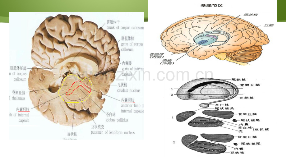 基底节脑出血护理查房ppt课件讲课稿.ppt_第3页