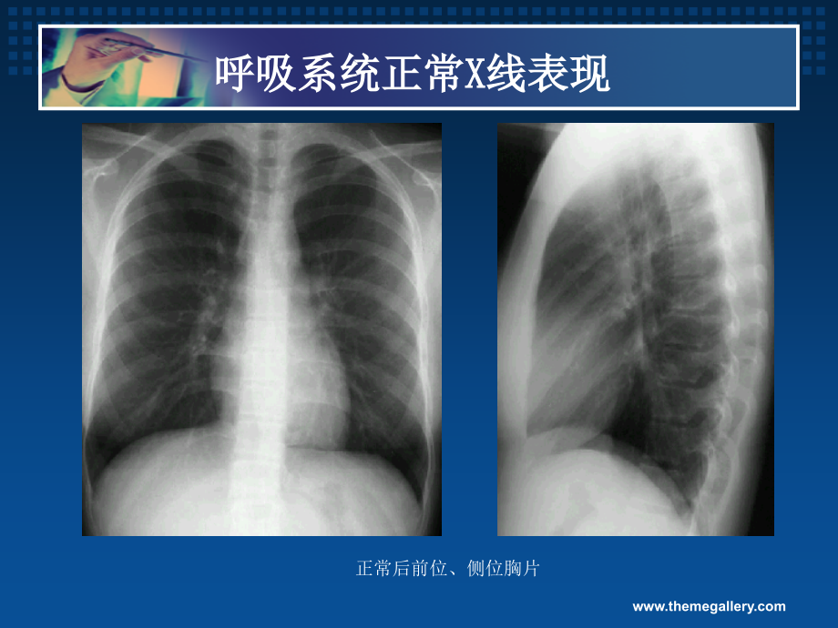 胸部疾病基本X线表现word版本.ppt_第2页