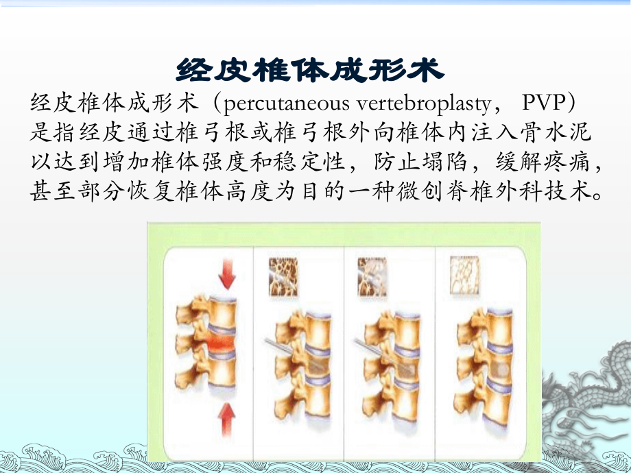 胸腰椎骨折的微创手术治疗说课材料.ppt_第3页