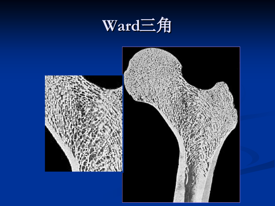 股骨颈骨折朱培训课件.ppt_第3页