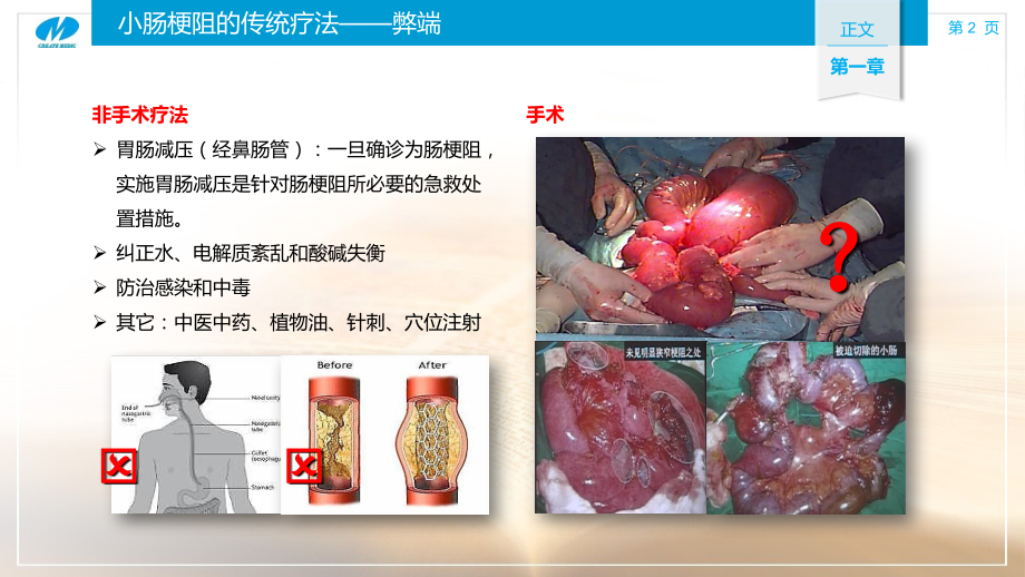 肠梗阻导管的临床应用及护理幻灯片课件.ppt_第2页