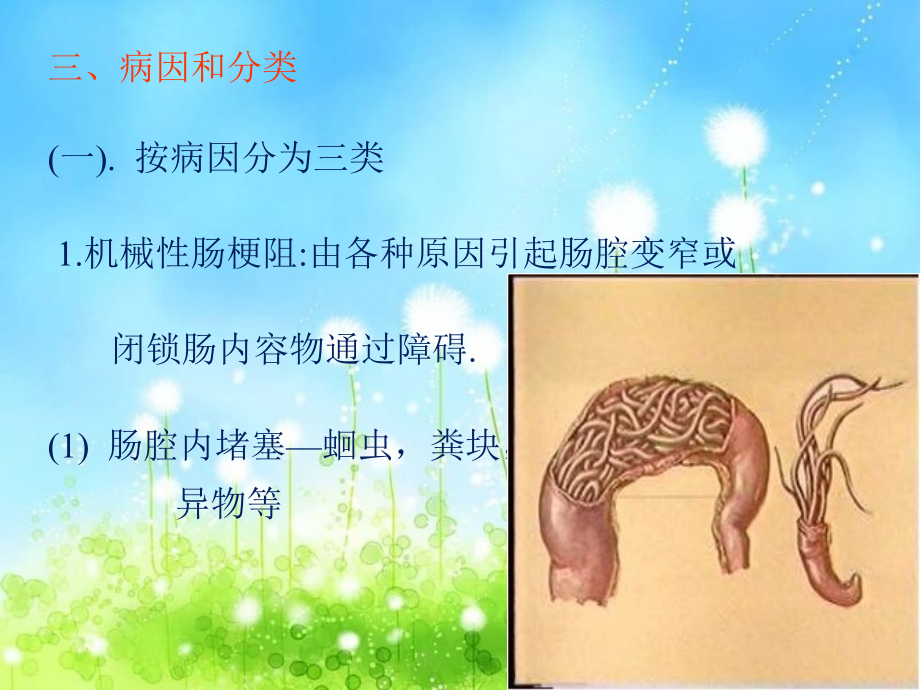 肠梗阻教学小讲座讲课讲稿.ppt_第3页