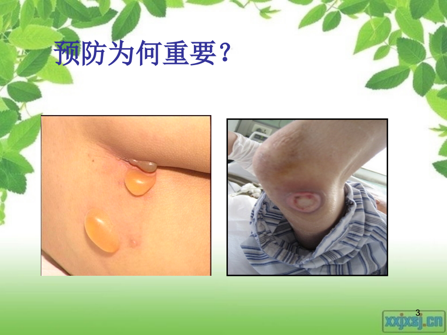 压疮的评估及护理.ppt_第3页