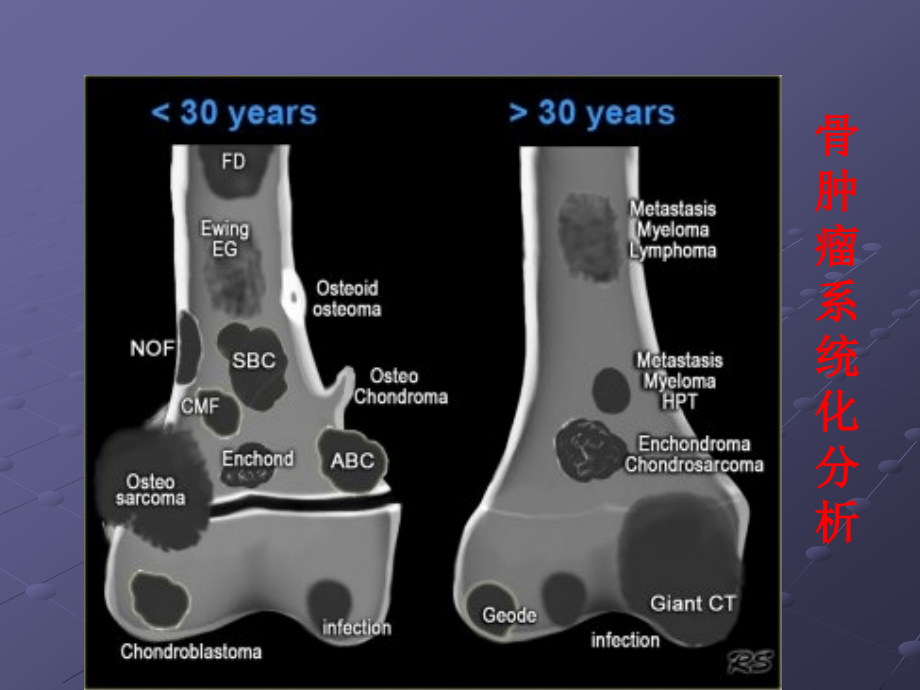 骨肿瘤—鉴别诊断.ppt_第3页