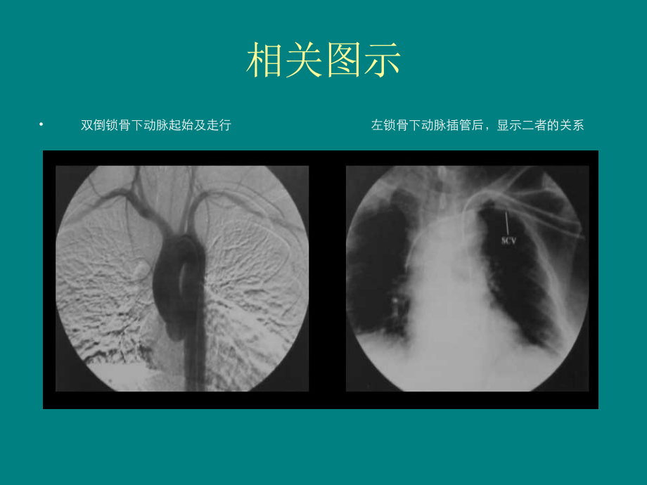 锁骨下A或V穿刺术.ppt_第3页