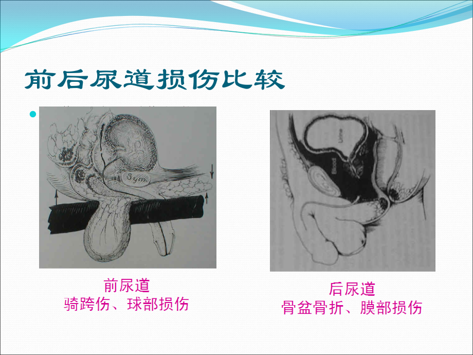 尿道损伤的治疗与护理.ppt_第3页