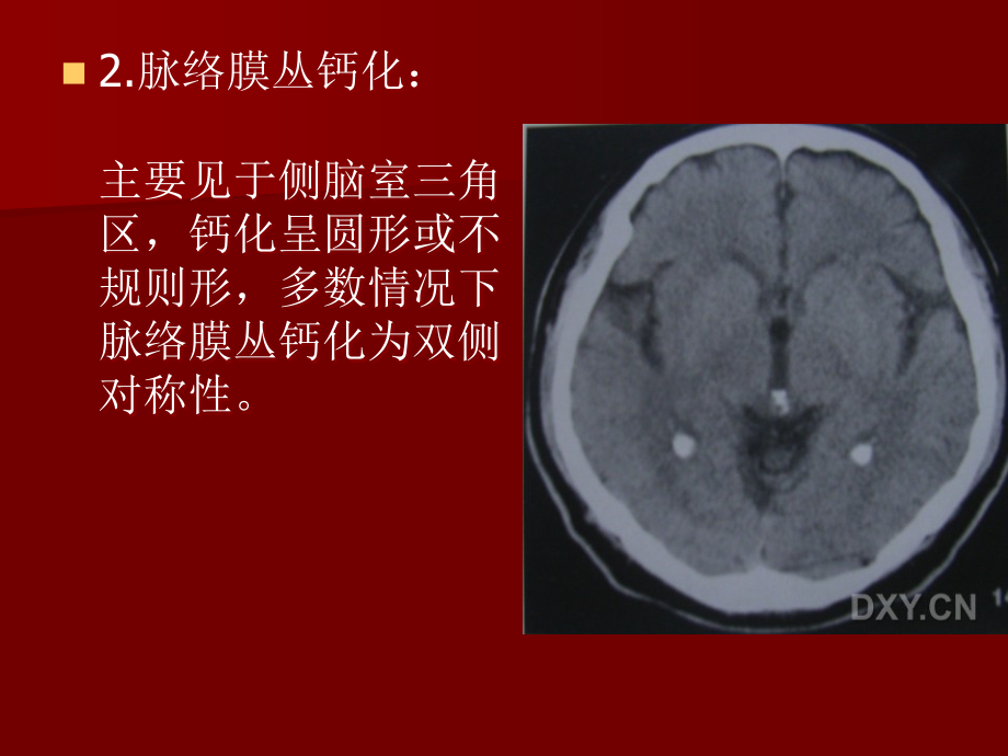 关于颅内钙化.ppt_第3页