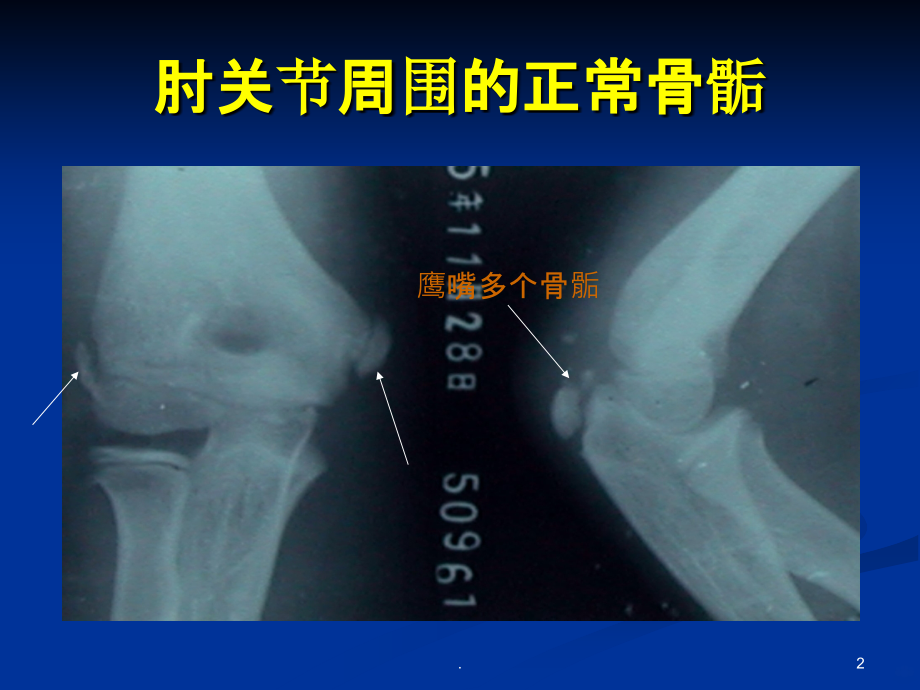 肱骨外髁骨折.ppt_第2页