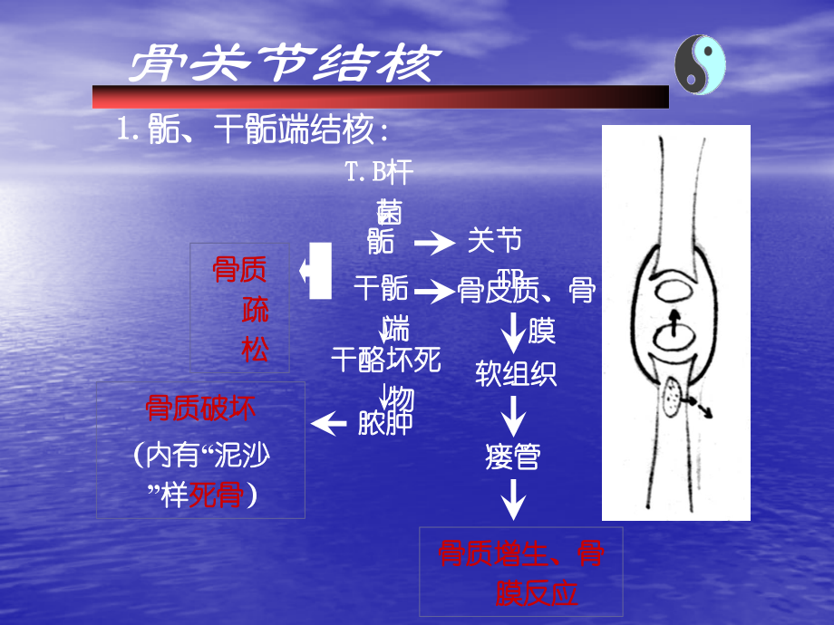 骨结核与肿瘤ppt课件.ppt_第3页