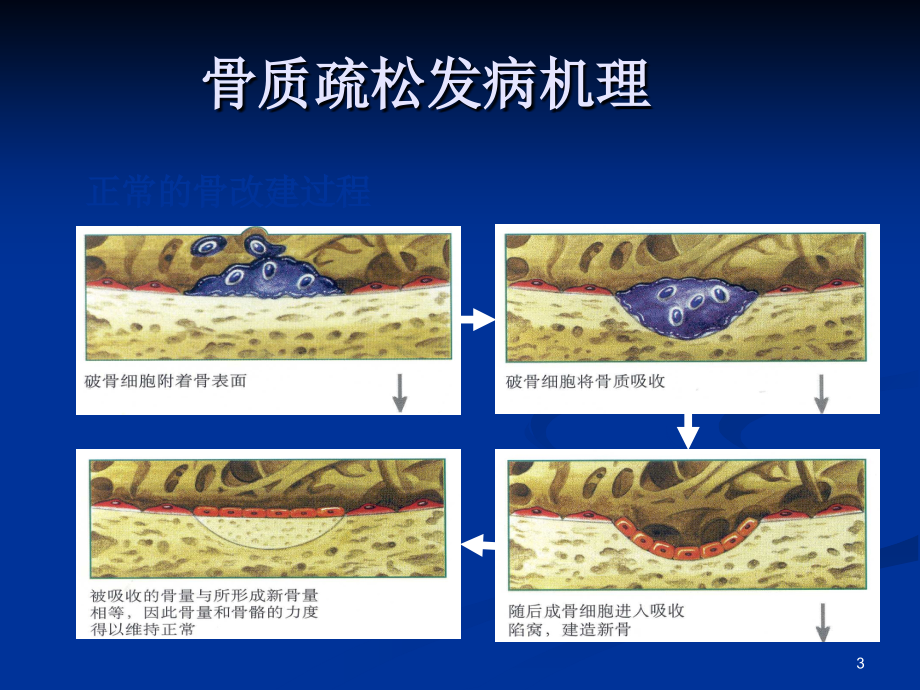 原发性骨质疏松症诊治指南.ppt_第3页