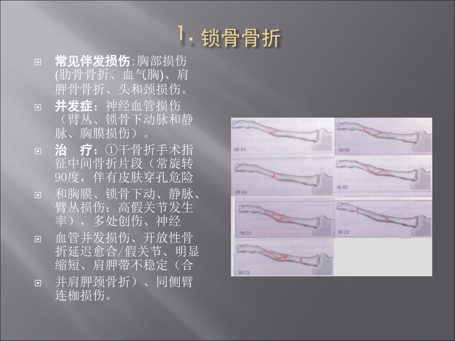 肩关节区域骨折与脱位-诊断分型及治疗.ppt_第3页