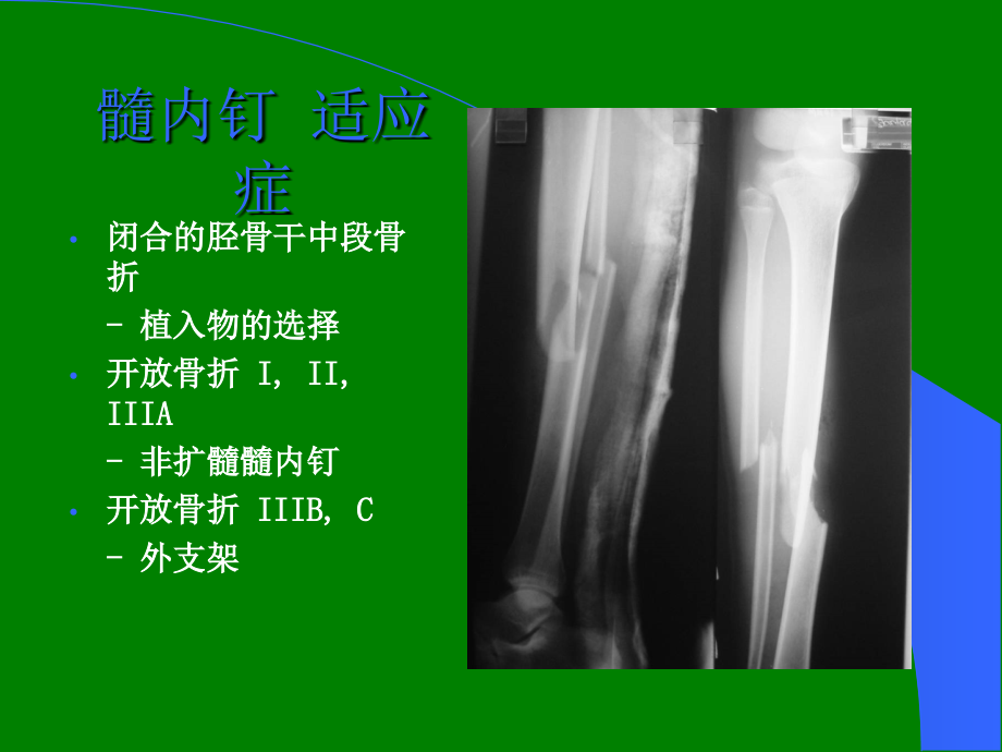 胫骨干骨折.ppt_第3页