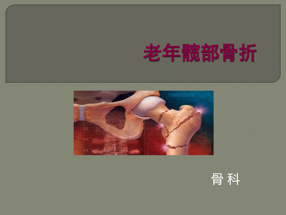 老年髋部骨折护理与配合.ppt_第1页