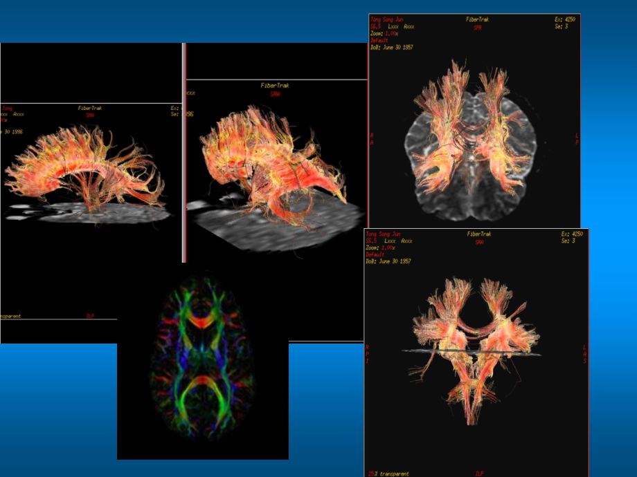 磁共振弥散张量成像ppt课件.ppt_第3页