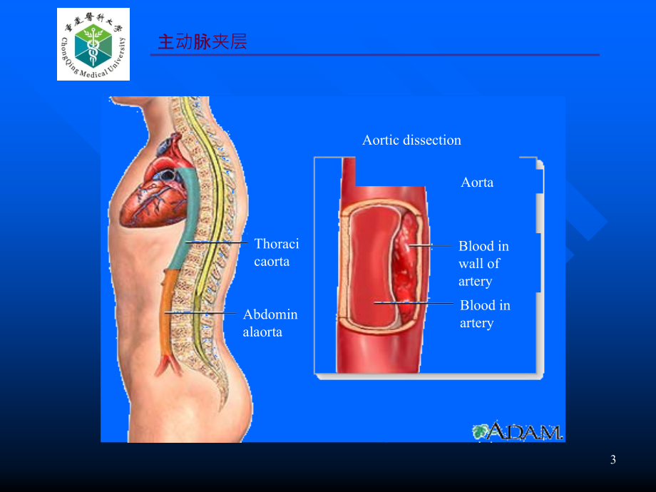 主动脉夹层的诊治ppt课件.ppt_第3页