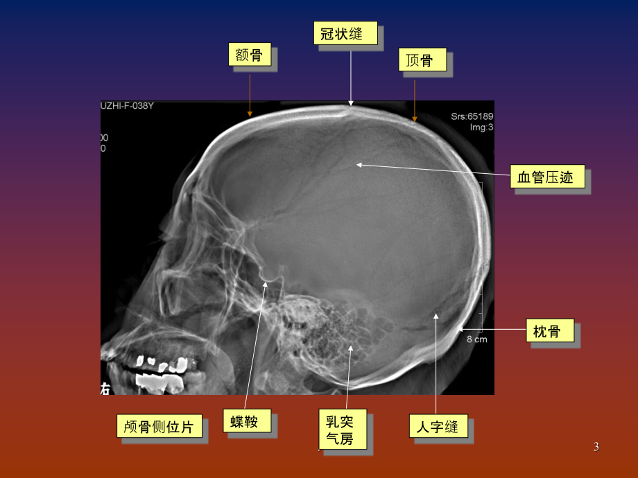 脑血管畸形影像学诊断.ppt_第3页