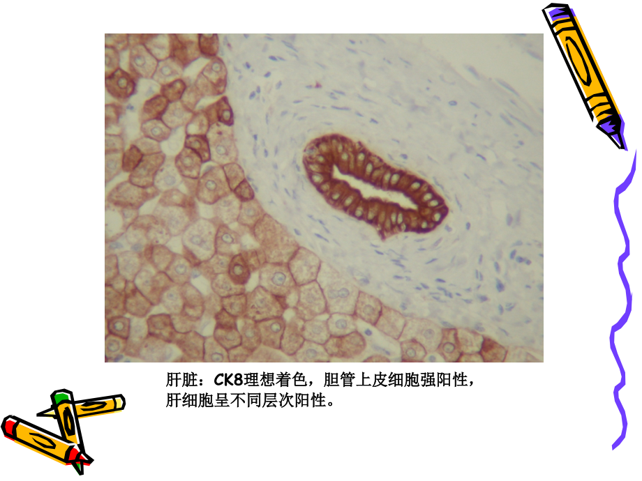 免疫组化结果判断及常见问题的分析.ppt_第3页