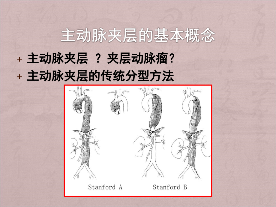 主动脉夹层的外科分型及治疗对策.ppt_第2页