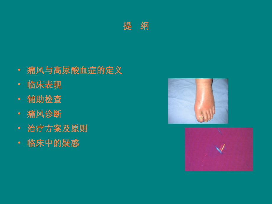 痛风诊治及疑惑.ppt_第2页