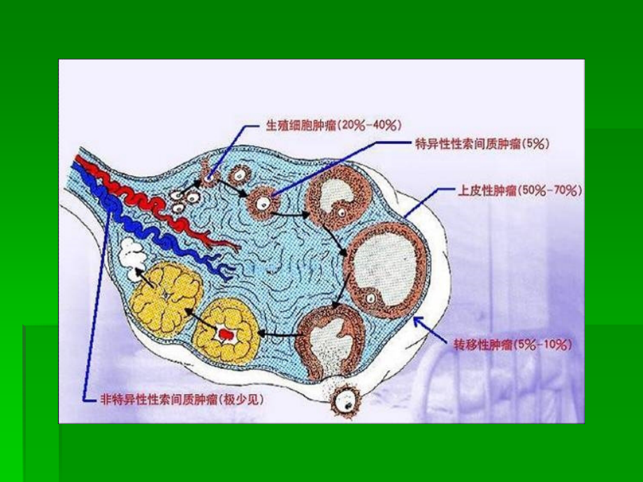 卵巢上皮源性肿瘤病变影像学表现.ppt_第3页