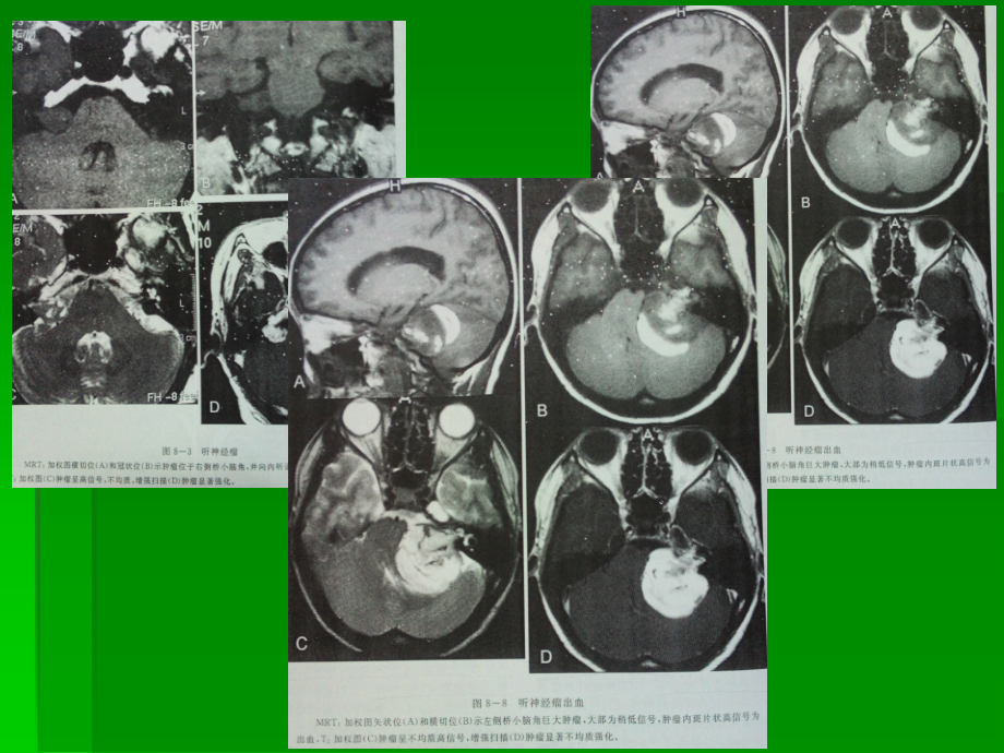 桥小脑角区占位病变ppt课件.ppt_第3页